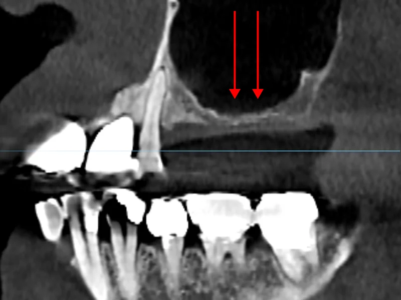 광범위한 골 흡수로 뼈가 거의 없는 상태