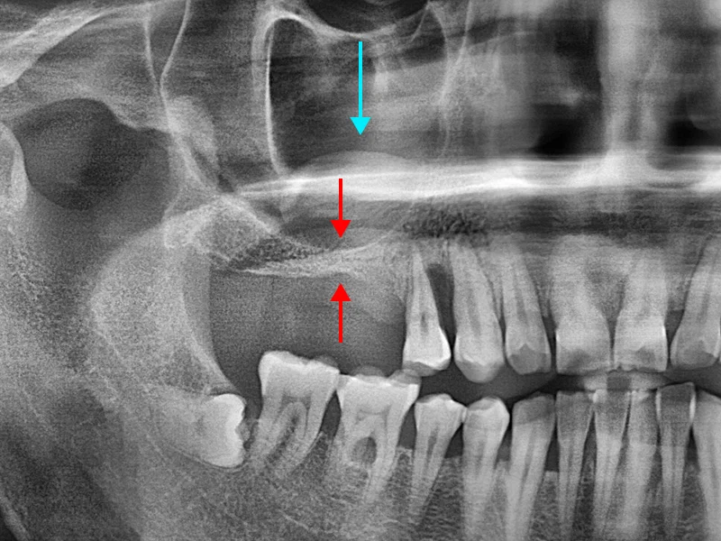 볼록 튀어 나온 물주머니 (Cyst) 존재함